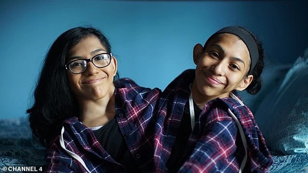 Chuyện hẹn hò của chị em song sinh dính liền gây sửng sốt - 2