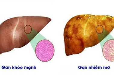 Uống nhiều rượu có thể gây bệnh gan nhiễm mỡ