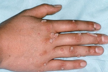 Giải mã chuyện nắm tay người chết, sờ quan tài chữa mụn cóc