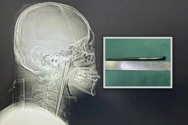 Người đàn ông sống 8 năm với chiếc đũa dài 12cm trong cổ họng