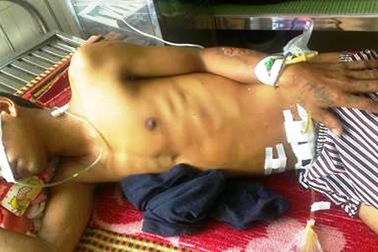 Cứu sống một bệnh nhân bị cây đâm thủng ruột non