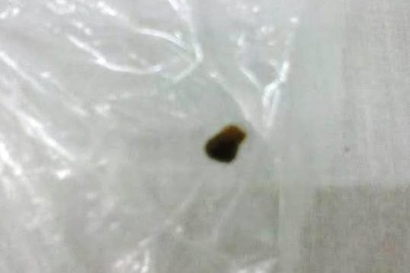 “Tiểu ra sỏi rồi, bác sĩ ơi!”