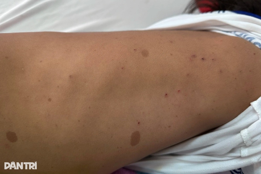Theo bố mẹ lên rẫy, bé gái bị ong đốt 200 vết trên cơ thể - 2 Theo bố mẹ lên rẫy, bé gái bị ong đốt 200 vết trên cơ thể - 2