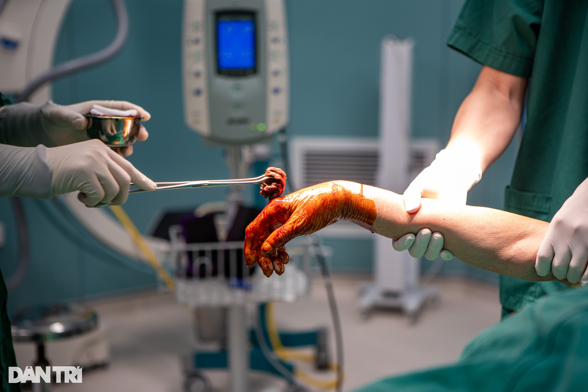 Tận mắt xem bác sĩ dùng máy khoan, đinh vít cứu cánh tay gãy - 4 Tận mắt xem bác sĩ dùng máy khoan, đinh vít cứu cánh tay gãy - 4