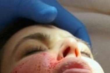 Chủ tịch Hội phẫu thuật Thẩm mỹ nói về làm đẹp bằng máu tự thân