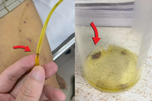 Mê ăn gỏi cá, bệnh nhân bị sán lúc nhúc chui ra từ ống dẫn lưu đường mật