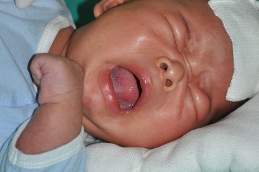 Xót thương bé 44 ngày tuổi bị bỏng than