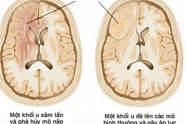 Dấu hiệu cảnh báo u não