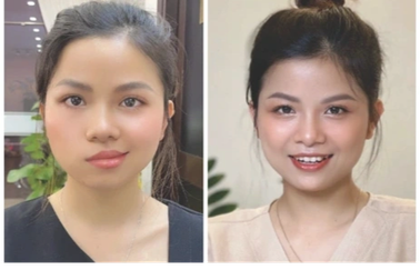 Bệnh nhân liệt mặt 3 tháng phục hồi nhờ y học cổ truyền