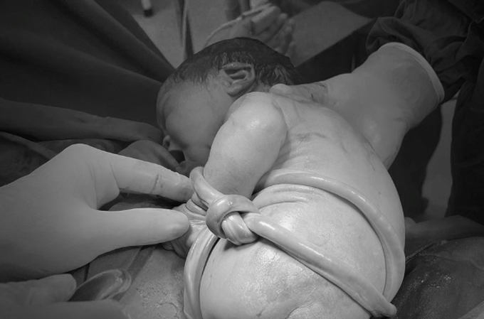 Dây rốn thắt nút và cuốn hai vòng xung quanh thân em bé. Ảnh: Bệnh viện cung cấp
