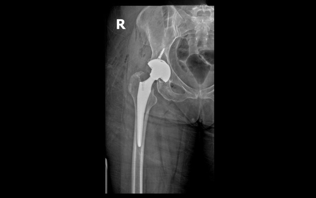 Un patient israélien retrouve sa mobilité grâce à une prothèse de hanche Superpath-3. Bệnh nhân Israel lấy lại vận động nhờ thay khớp háng Superpath - 3
