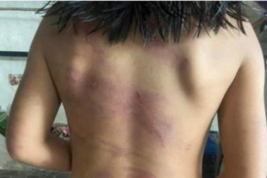 Cha dượng và mẹ ruột  đánh đập bé gái thương tích 24%