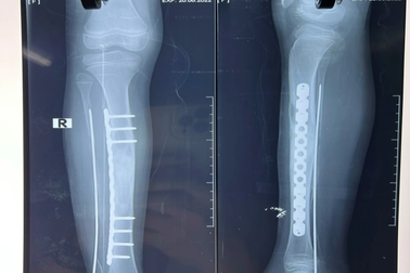 Bị đau chân, bé gái 10 tuổi phát hiện u xương chày dài 12cm