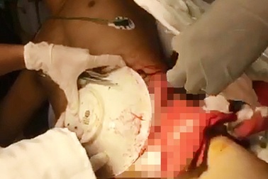 Rách toạc bụng, lòi ruột vì lưỡi cưa văng trúng