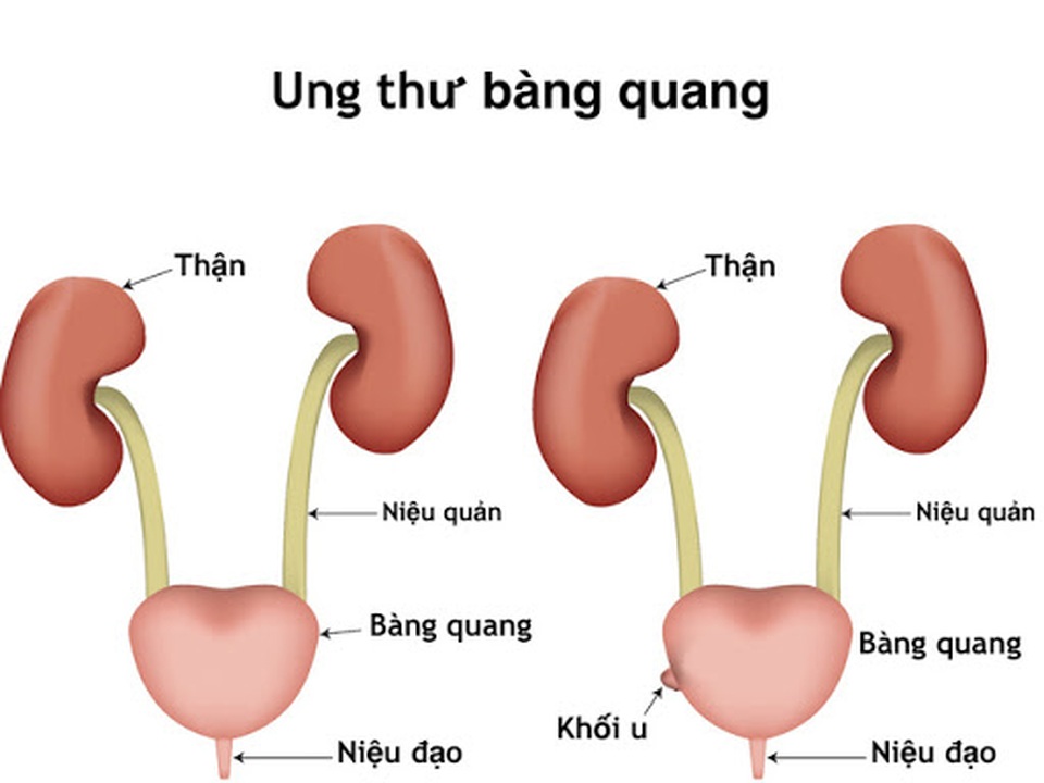 Dấu hiệu nhận biết ung thư bàng quang - 1 Dấu hiệu nhận biết ung thư bàng quang - 1
