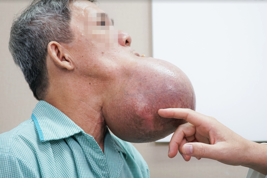 Người đàn ông nguy kịch vì khối u to bằng đầu sắp nổ tung dưới miệng - 1 Người đàn ông nguy kịch vì khối u to bằng đầu sắp nổ tung dưới miệng - 1