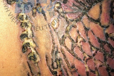 Nam thanh niên chằng chịt vết mủ trên vai do xoá xăm