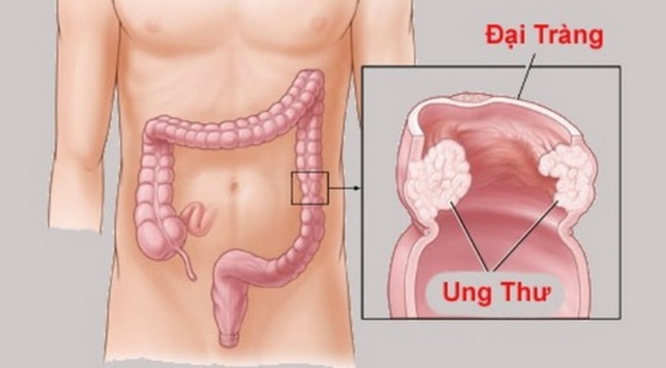 Rối loạn tiêu hóa dấu hiệu ung thư đại trực tràng? - 1 Rối loạn tiêu hóa dấu hiệu ung thư đại trực tràng? - 1