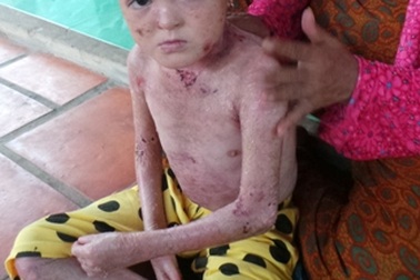 Xót xa bé 11 tuổi mắc bệnh "lột da ếch" trong cảnh mẹ tâm thần, cha bỏ đi biệt tích