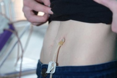 Cô gái không ăn không uống trong suốt 5 năm