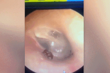 Rùng mình cảnh bác sĩ bắt kiến kiếm ăn trong… tai bệnh nhân