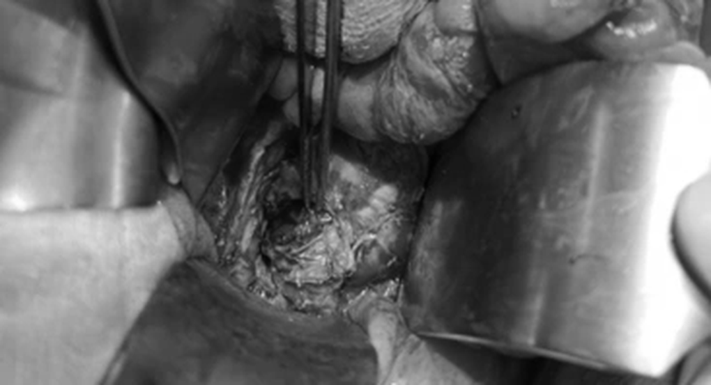 Dùng cà phê để thụt thải độc, nữ bệnh nhân vỡ trực tràng - 1