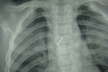 Đinh ghim găm vào phế quản bé trai 6 tuổi