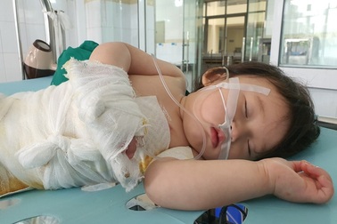 Đau nhói lòng cảnh bé gái 14 tháng tuổi ngã vào nồi nước sôi nguy kịch