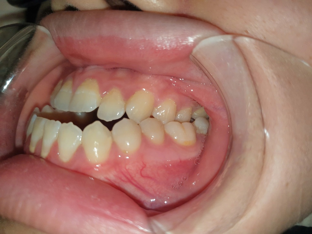 Làm sao xử lý gương mặt lưỡi cày? - 2 Làm sao xử lý gương mặt lưỡi cày? - 2