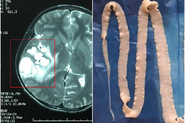 Sán làm tổ trong não vì món ăn "lấy may" đầu tháng