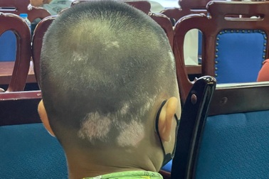 Bệnh bạch biến: Những đốm trắng loang lổ có thể trở về màu da bình thường