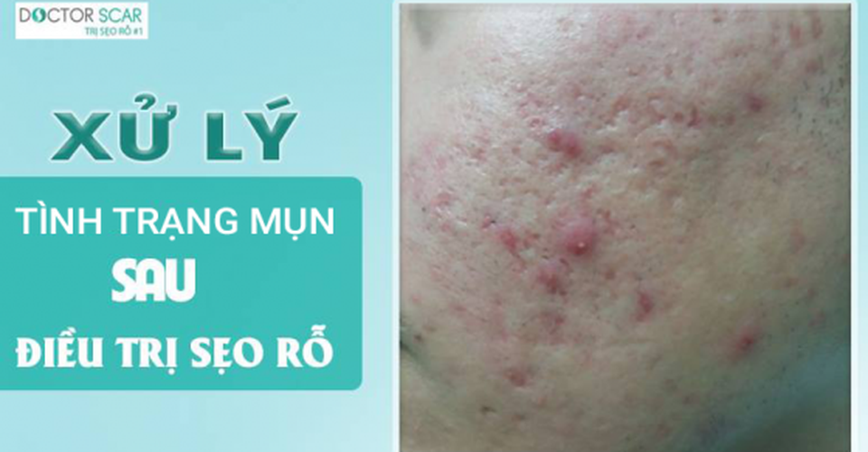 Bác sĩ da liễu giải đáp thắc mắc về việc nổi mụn sau khi điều trị sẹo rỗ - 3 Bác sĩ da liễu giải đáp thắc mắc về việc nổi mụn sau khi điều trị sẹo rỗ - 3