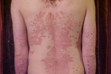 Toàn thân mọc vẩy sau một đêm thức trắng