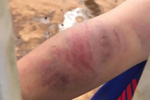 Khởi tố người bố và bà nội bạo hành dã man bé 9 tuổi