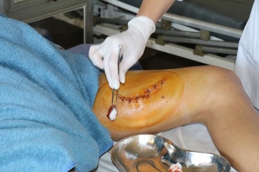 Dùng đùi giữ bình rượu ổi để mở nắp, người đàn ông nhập viện cấp cứu