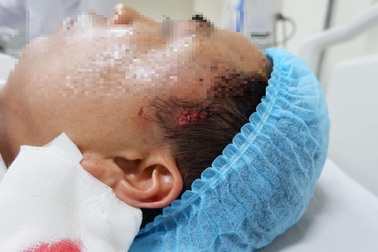 Nam thanh niên chảy máu ồ ạt khi "độn" thái dương tại cơ sở không phép