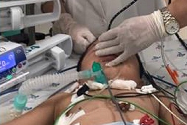Bé 3 tuổi ngưng tim, ngưng thở vì hóc hạt mãng cầu