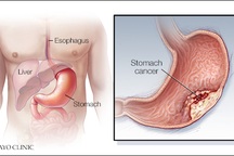 Ai cần tầm soát sớm ung thư dạ dày?