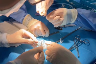 Bước tiến mới trong kỹ thuật đặt stent động mạch chủ, biến đại phẫu thành tiểu phẫu