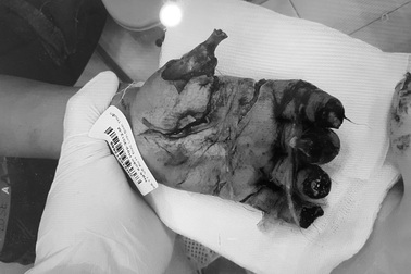 Đốt pháo chơi Tết, bé trai 9 tuổi dập nát bàn tay