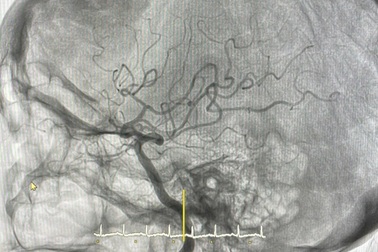 Cục máu đông khiến cụ bà suýt mất hàng triệu tế bào não mỗi phút