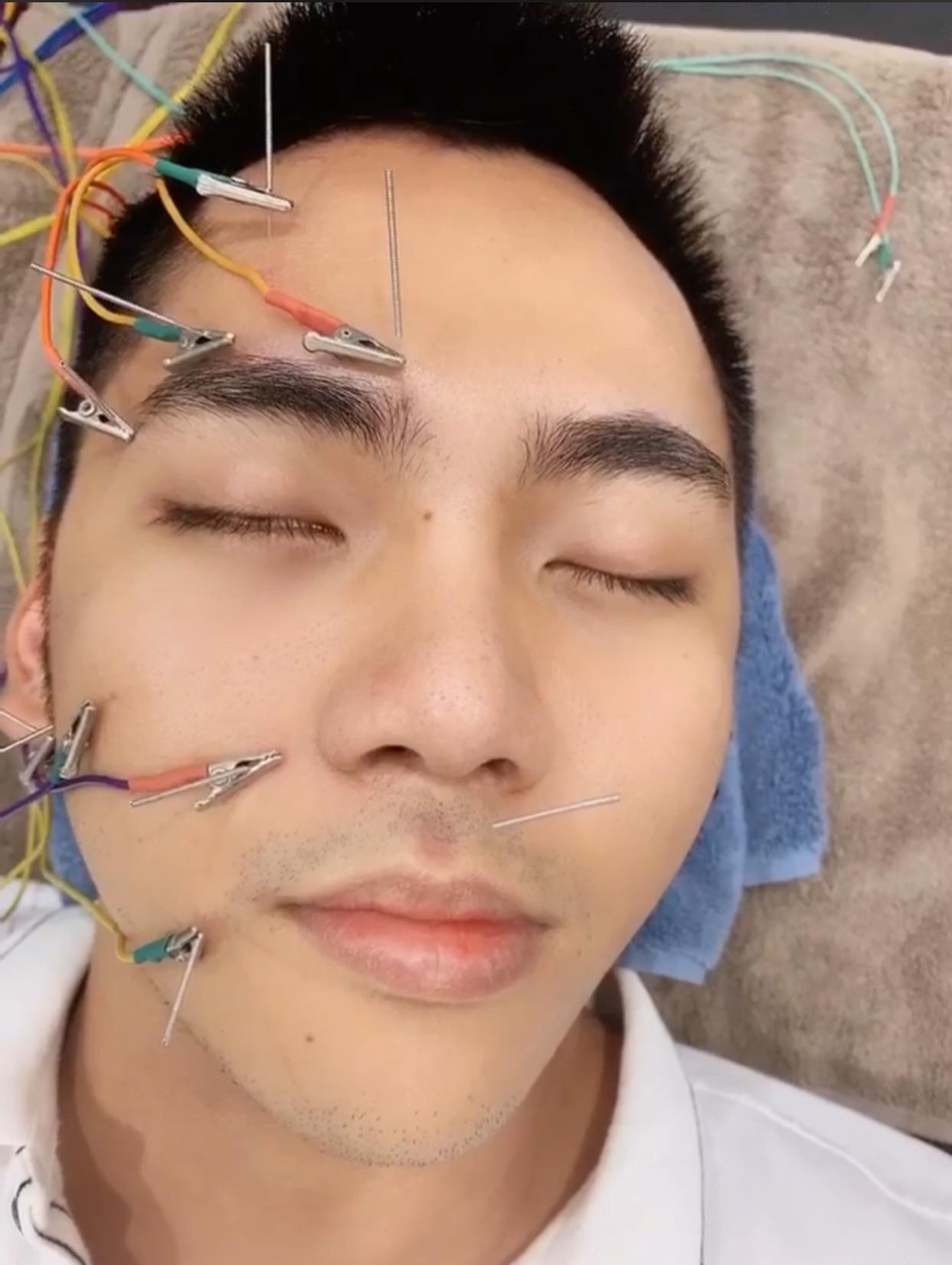 Lời cảnh tỉnh của chàng Youtuber sau hành trình chữa trúng gió méo miệng - 8 Lời cảnh tỉnh của chàng Youtuber sau hành trình chữa trúng gió méo miệng - 8