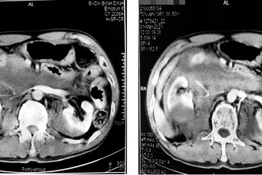 Phẫu thuật cứu người bị chấn thương thận móng ngựa hiếm gặp