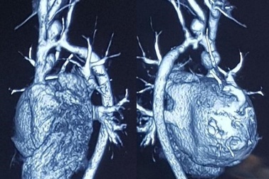 Bé trai 8 tuổi được hồi sinh nhờ mạch máu được hiến tặng từ người chết não