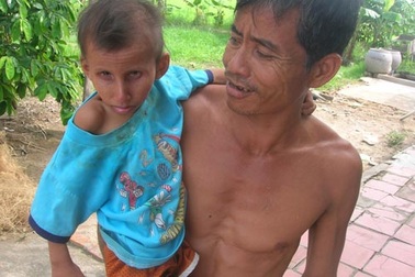 Một thiếu niên chết vì lão hóa sớm