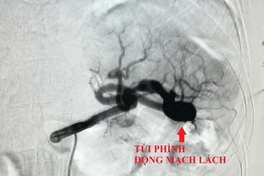Đau bụng âm ỉ, coi chừng mắc bệnh lý nguy hiểm