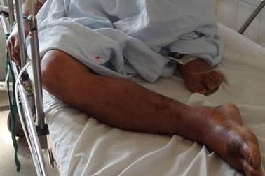 Cứu sống bệnh nhân bị rắn cắn đã ngưng tim