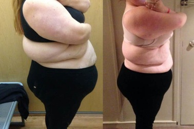 Cô gái béo phì từng nặng 160 kí giảm cân ngoạn mục tìm lại sự tự tin