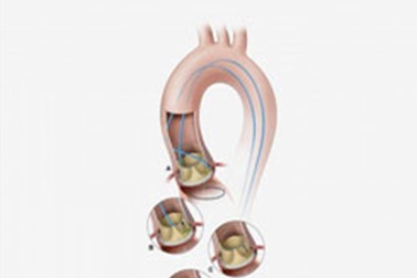 Phương pháp mới giúp thay thế van tim an toàn hơn