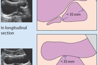 U xơ tuyến tiền liệt: Đồng hành với tuổi tác
